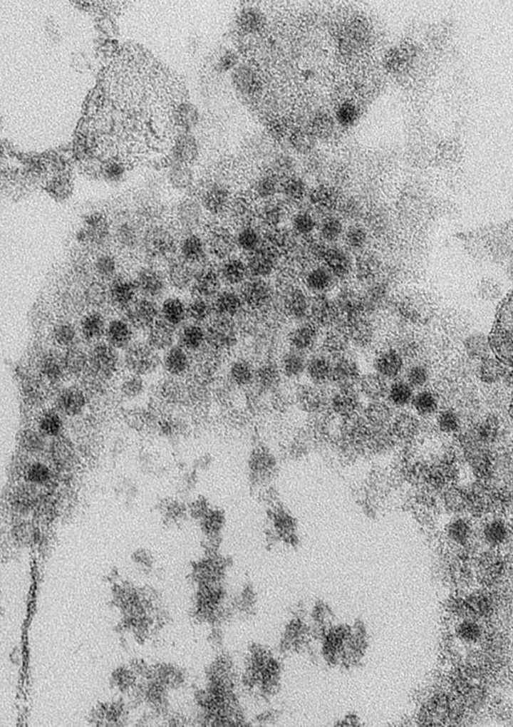 Acute flaccid myelitis requires galvanized research response | National Institutes of Health – National Institutes of Health