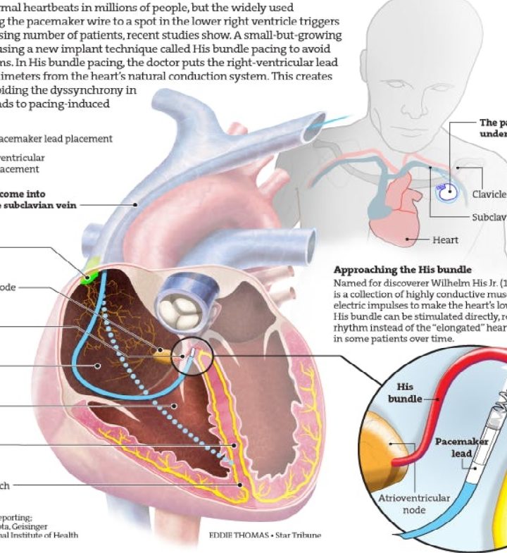 Using the heart’s natural pacemaker wires – Star Tribune
