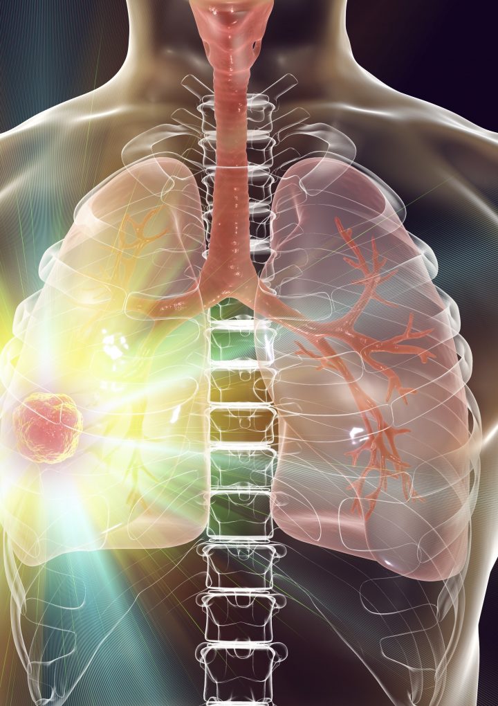 Immunotherapy Drug Shows Potential to Cure Advanced Lung Cancer – Yale News