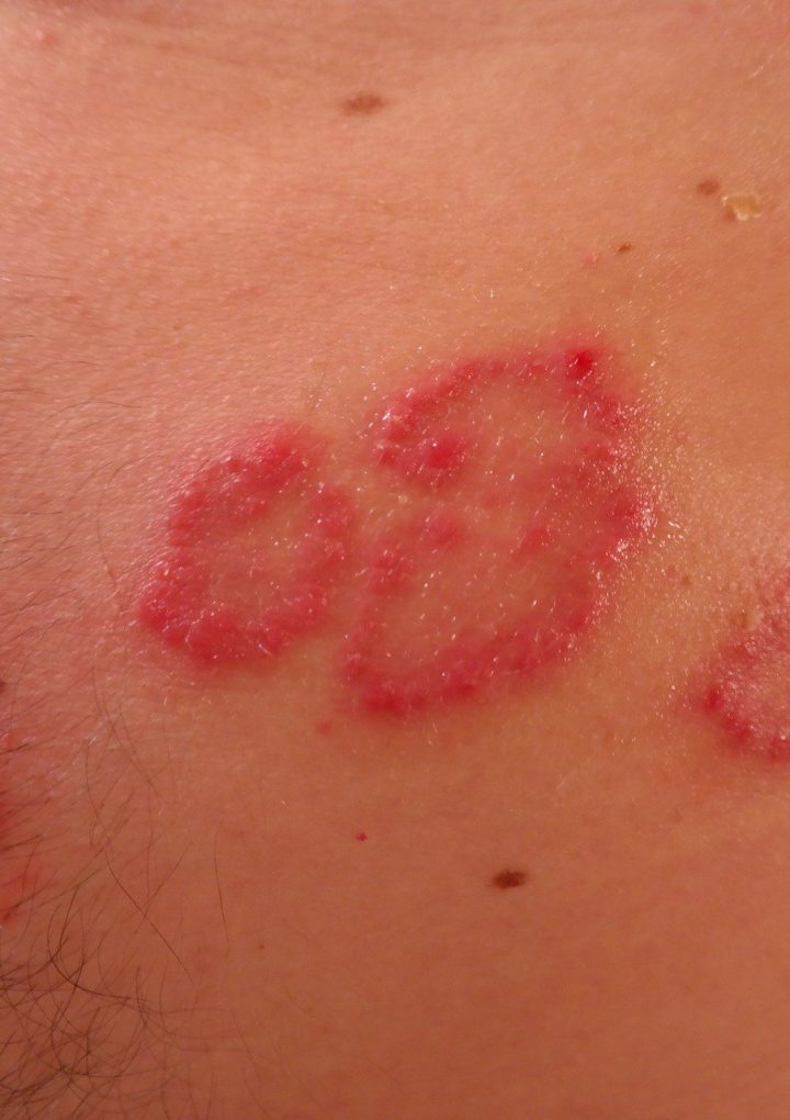 Managing Psoriasis with a Plant-Based Diet – One Green Planet