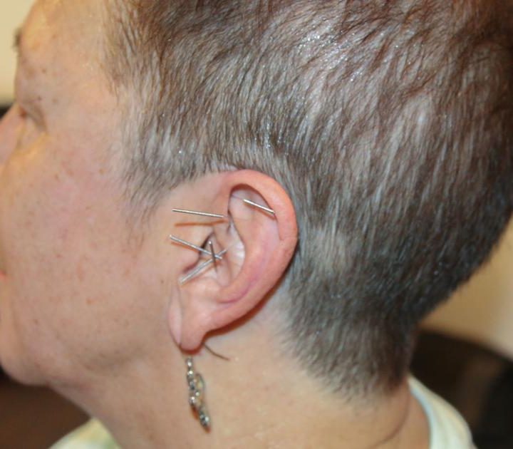 State board OKs acupuncture treatment in fight against opioid abuse – Arizona Daily Star