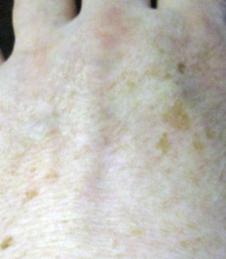 Home remedies for pigmentation – Medical News Today
