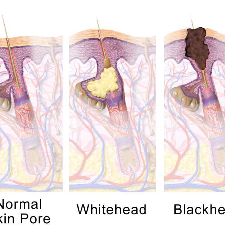 Acne Could Be A ‘Natural Transient State’ Linked To Teenage Skin’s Changing Flora, Study Suggests – IFLScience