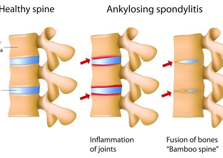 Acupuncture And Herbs Beat Drug For Ankylosing Spondylitis – HealthCMi
