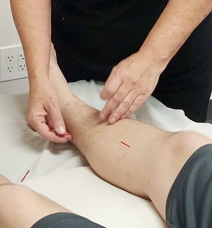 Acupuncture can help many conditions – Fallbrook / Bonsall Villlage News