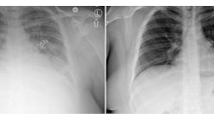 Amid Vape Pen Lung Disease Deaths: What Exactly Is Vitamin E Oil? – Leafly
