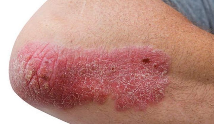 Naturopathy treats 45-year-old suffering from psoriasis – Express Healthcare