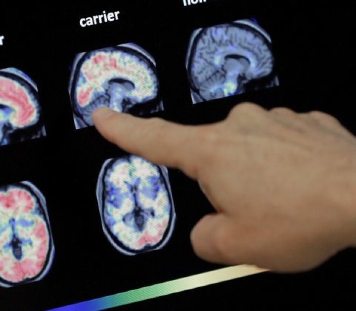 Alzheimer’s risk may be 75% higher for people who eat trans fats – WKBW-TV