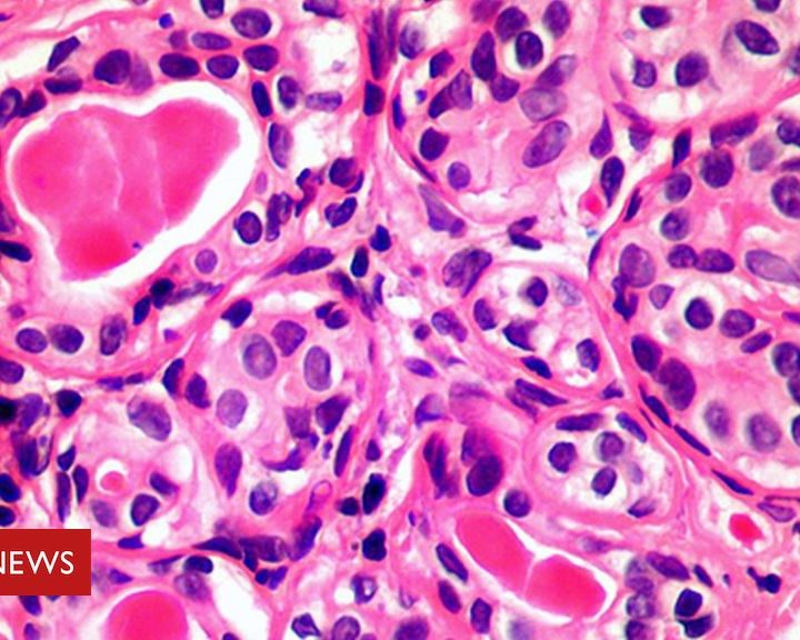 Immune discovery ‘may treat all cancer’ – BBC News