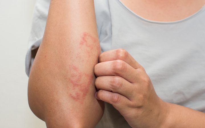 Boosting natural killer cells in mice with eczema relieves condition – Drug Target Review